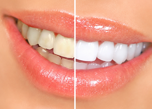 Teeth whitening treatment Kolhapur
